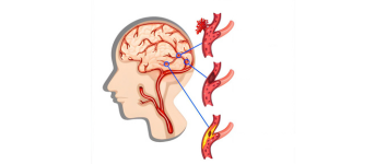 Stroke Treatment